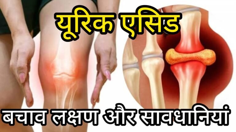 विशेष स्वास्थ्य खबर: बढ़ता हुआ Uric Acid – कारण, लक्षण, बचाव और घरेलू उपाय…